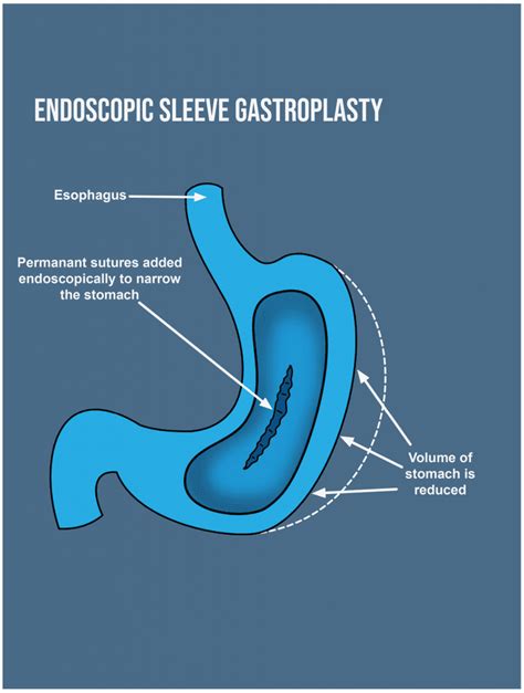 point endoscopic sleeve gastroplasty tampa